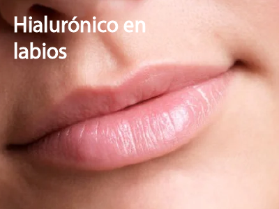 Acido Hialuronico para labios